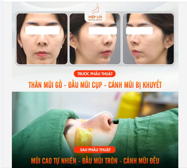 BIẾN HÓA NHẸ NHÀNG, SỞ HỮU DÁNG MŨI HOÀN HẢO