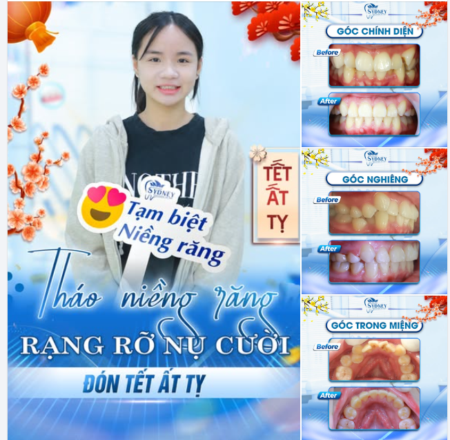 THÁO NIỀNG RĂNG - RẠNG RỠ NỤ CƯỜI ĐÓN TẾT ẤT TỴ