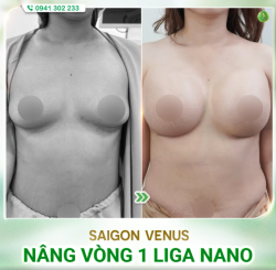 CÔNG NGHỆ NÂNG V1 LIGA NANO, GIẢI PHÁP LÀM ĐẸP ĐÁNG ĐỂ LỰA CHỌN