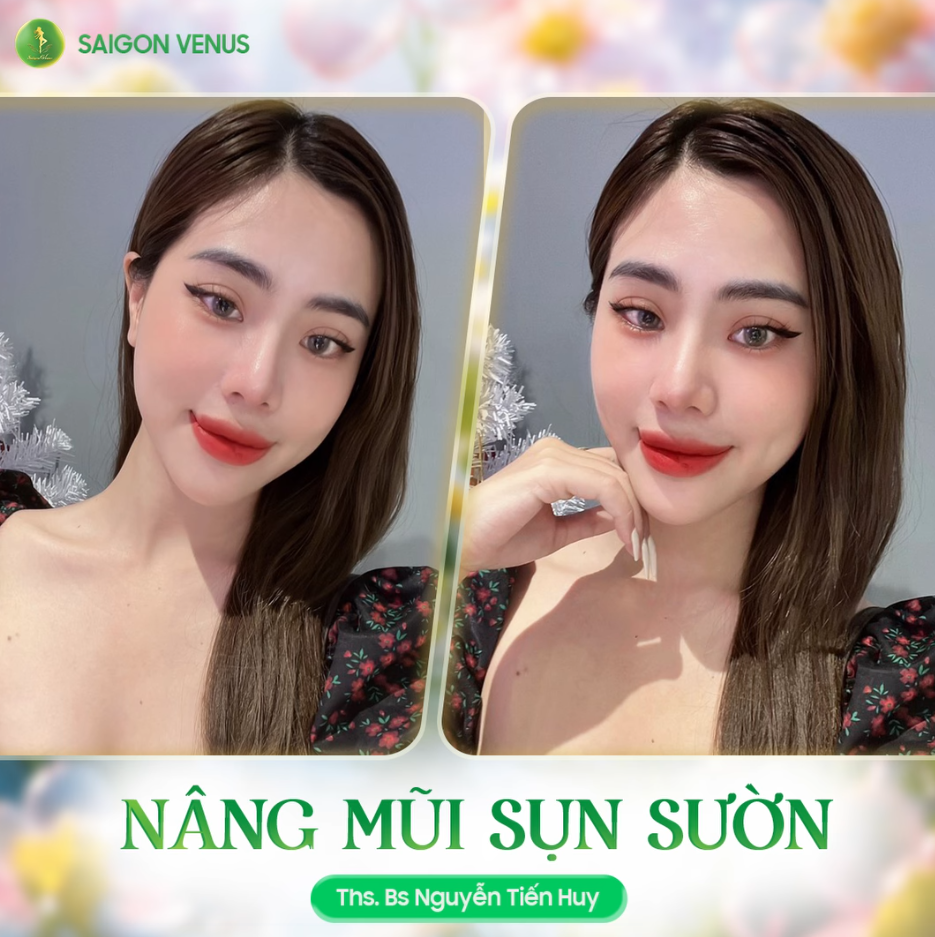 KĨ THUẬT NÂNG MŨI SỤN SƯỜN MANG ĐẾN DÁNG MŨI HOÀN HẢO