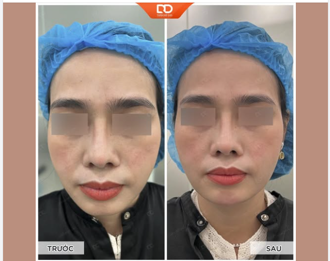 TIÊM CẰM VLINE - NHẸ NHÀNG - HIỆU QUẢ NGAY