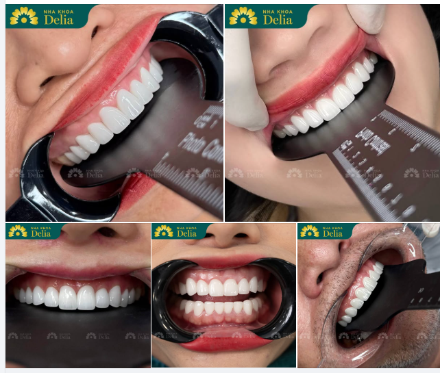 Thứ 2 là ngày đầu tuần, cùng Delia ngắm nhìn những bộ răng sứ mới nhất được đội ngũ Bác sĩ kiến tạo trong buổi sáng hôm nay.