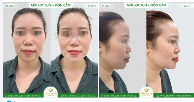 Charming vừa có cơ hội giúp nàng khách xinh đẹp "nâng cấp" diện mạo với combo nâng mũi lót sụn và độn cằm.