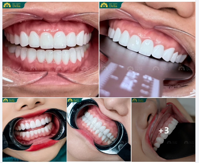 8/3 đang đến gần, còn gì tuyệt hơn việc tự thưởng cho mình một nụ cười rạng rỡ?