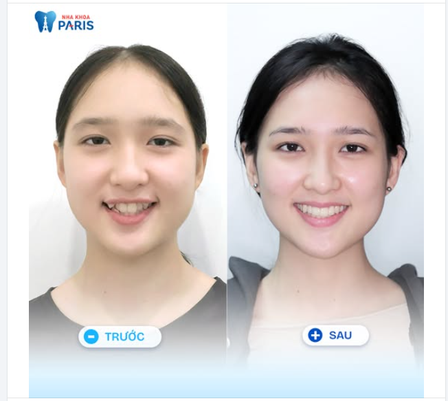 RĂNG KHỂNH CHƯA CHẮC ĐÃ DUYÊN NHƯNG CHẮC CHẮN KHÓ VỆ SINH