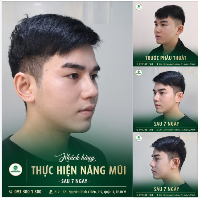 THẦN THÁI THĂNG HẠNG – DÁNG MŨI HOÀN HẢO