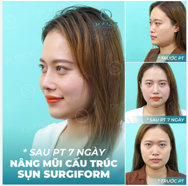 Nhờ nâng mũi CẤU TRÚC SỤN TAI (đặt sống bằng sụn Surgiform), vẻ ngoài của bạn ấy đã khác xa lúc trước, xinh đẹp hơn, đường nét cũng cân đối hài hòa.