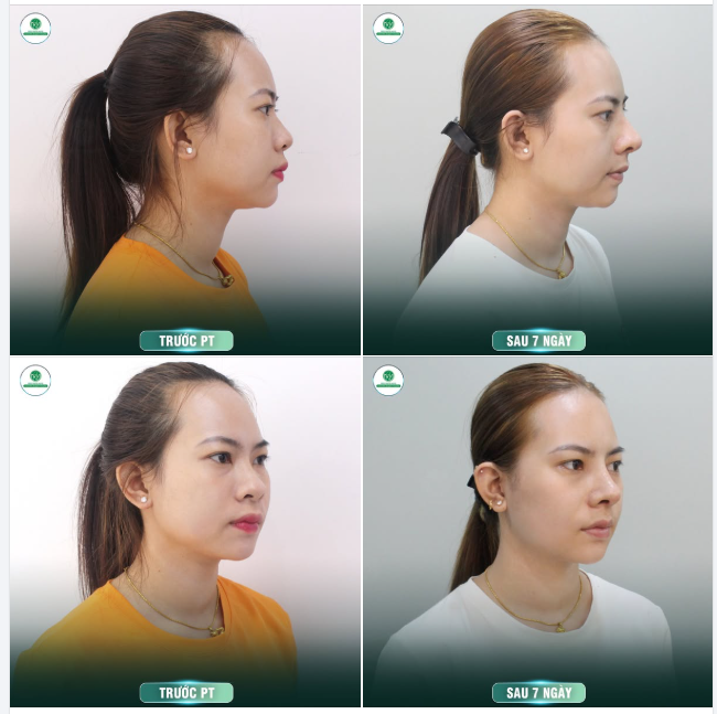 THAY ĐỔI TOÀN DIỆN NHAN SẮC CÙNG DÁNG MŨI S LINE