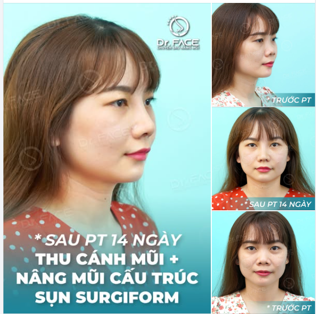 KHẮC PHỤC CHIẾC MŨI “TIỀN RA” CHỈ 1 NỐT NHẠC