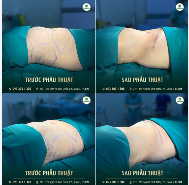 HÚT MỠ CĂNG DA BỤNG - LẤY LẠI ĐƯỜNG NÉT THON GỌN
