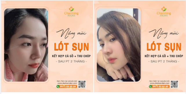 Chị em ơi, nhìn nàng khách sau khi nâng mũi lót sụn kết hợp cà gồ và thu chóp mũi mà mê quá luôn.