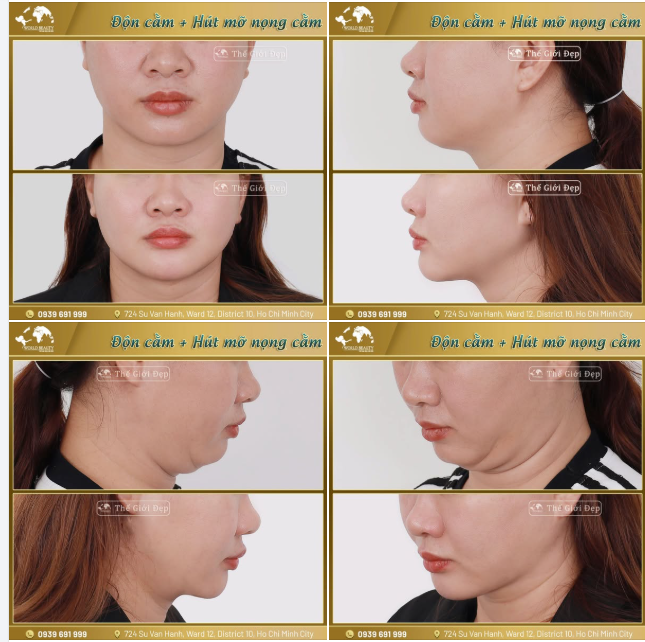 Kết quả sau thực hiện combo Hút m.ỡ nọng cằm + Độn cằm Surgiform cho quý Cô bởi đội ngũ Bác sĩ Thế Giới Đẹp!