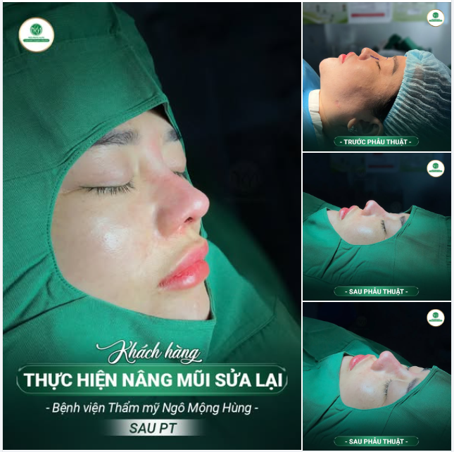CẢ MỘT BẦU TRỜI NHAN SẮC CHỈ SAU 1 CA NÂNG MŨI SỬA LẠI!