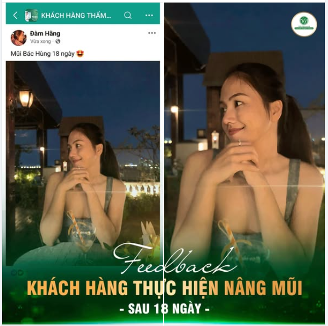 DÁNG MŨI SAU 18 NGÀY THỰC HIỆN