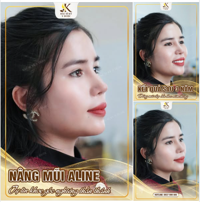 NÂNG MŨI ALINE – TỰ TIN KHOE GÓC NGHIÊNG THẦN THÁNH