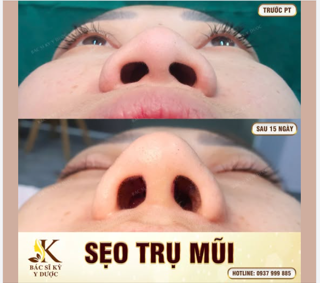 CHI TIẾT QUAN TRỌNG QUYẾT ĐỊNH SỰ TINH TẾ TRONG NÂNG MŨI