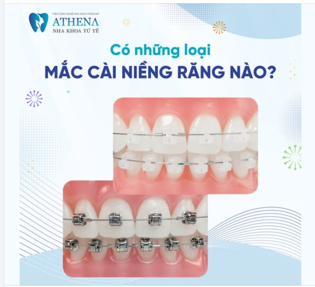 Niềng răng mắc cài là phương pháp chỉnh nha phổ biến, được chia thành nhiều loại khác nhau, mỗi loại đều có ưu và nhược điểm riêng.