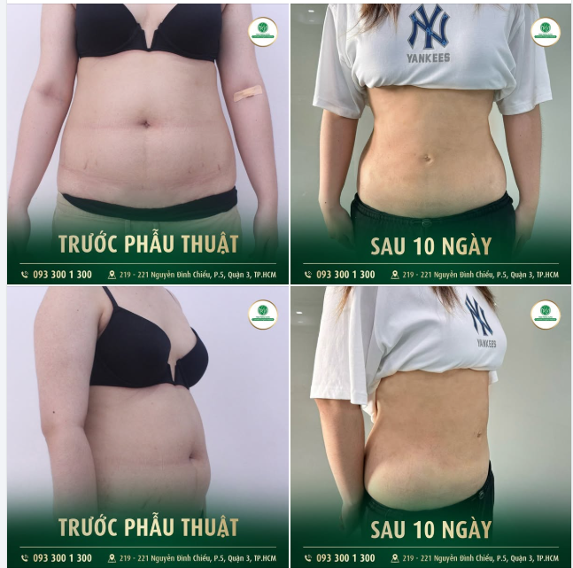 BẠN ĐANG LO LẮNG VỀ MỠ THỪA?  Tự ti vì vòng eo "quá khổ" – không dám diện đồ đẹp?