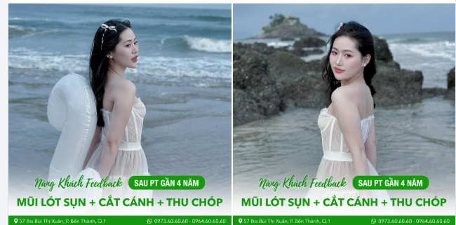 Cùng ngắm nhìn nàng khách xinh đẹp của chúng ta, người đã thực hiện nâng mũi lót sụn, cắt cánh mũi và thu chóp tại Thẩm mỹ viện Charming cách đây gần 4 năm.