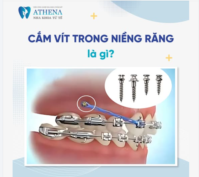 Nếu bạn đang niềng răng hoặc chuẩn bị niềng và nghe đến thuật ngữ "cắm vít chỉnh nha" nhưng chưa hiểu rõ, thì đừng bỏ qua bài viết này.