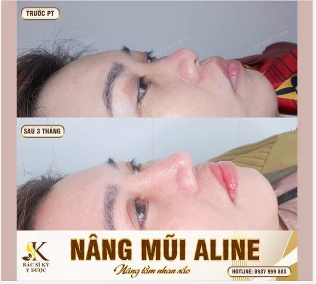 NÂNG MŨI ALINE – THAY ĐỔI DIỆN MẠO CHỈ SAU 3 THÁNG!