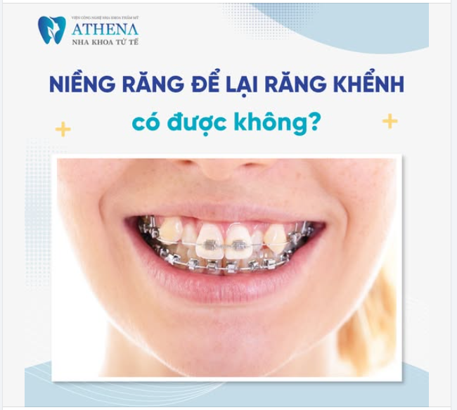 Răng khểnh là nét duyên dáng tự nhiên, giúp nụ cười thêm phần tươi tắn và cuốn hút.