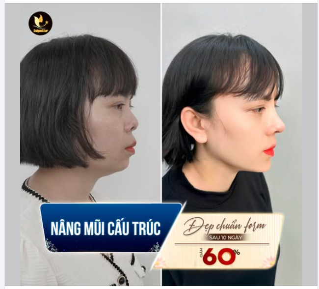 NÂNG MŨI CẤU TRÚC SỬA LẠI KHẮC PHỤC MŨI HỎNG - ĐẸP CHUẨN FORM SAU 10 NGÀY