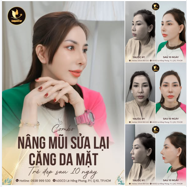 NÂNG MŨI SỬA LẠI + CĂNG DA MẶT MŨI CAO SANG - DA SÁNG MỊN MÀNG