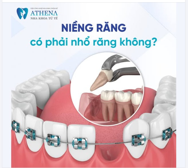 NIỀNG RĂNG CÓ PHẢI NHỔ RĂNG KHÔNG?
