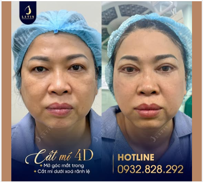 Trẻ Hóa Đôi Mắt Cho Khách Hàng U60