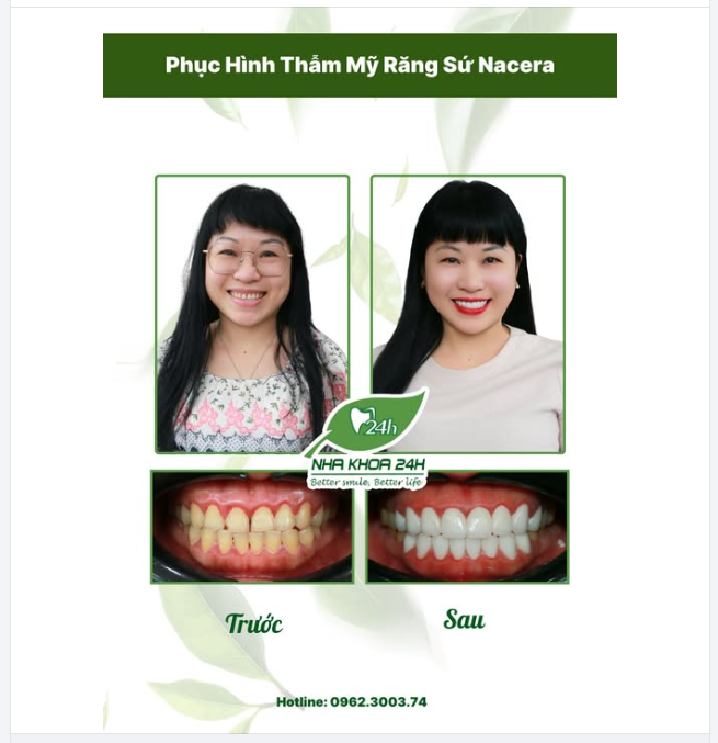 TỰ TIN TỎA SÁNG VỚI RĂNG SỨ THẨM MỸ NACERA