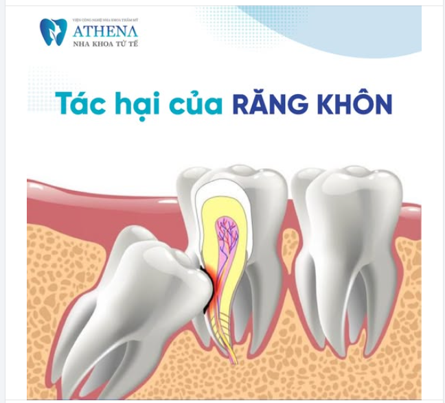 5 tác hại của Răng khôn đừng chủ quan