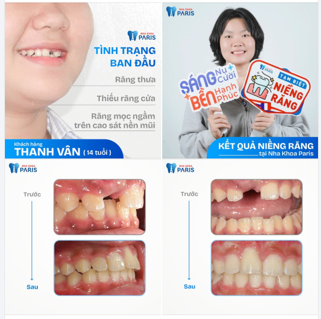GẤP ĐÔI SỰ TỰ TIN NHỜ NIỀNG RĂNG