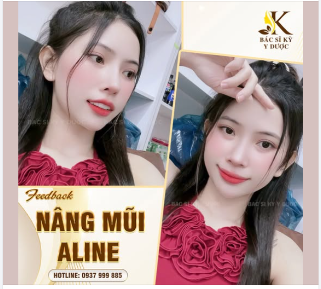 NÂNG MŨI ALINE - ĐẸP THẬT, TỰ TIN THẬT