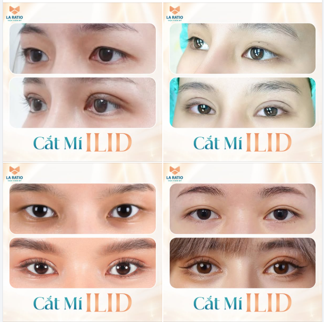 CÔNG NGHỆ CẮT MÍ ILID TẠI LA RATIO