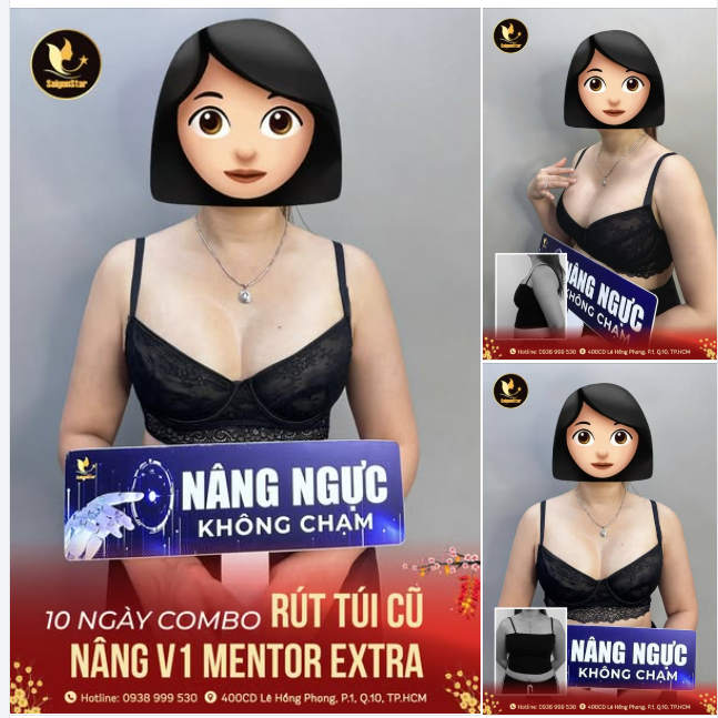 NÂNG NGỰC SỬA LẠI XỬ LÝ BAO XƠ THÀNH CÔNG