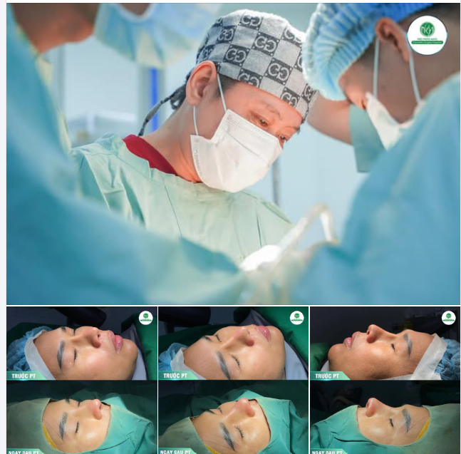 MŨI S LINE SỬA LẠI CHO BẠN KHÁCH ĐÃ LÀM NƠI KHÁC