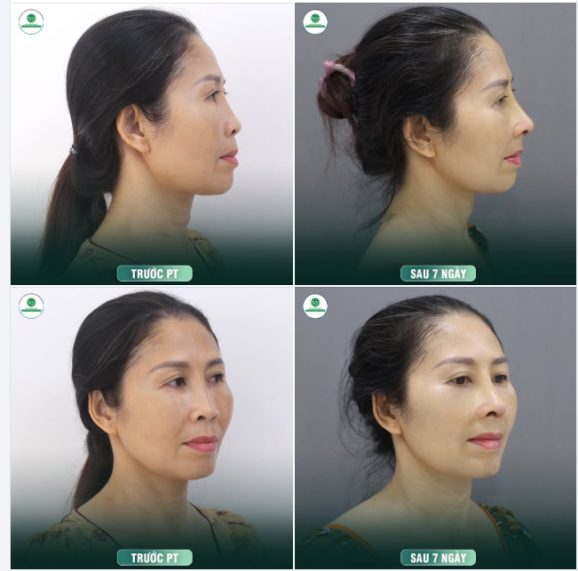 MŨI THẤP, GỒ KHẮC PHỤC NHƯ THẾ NÀO??