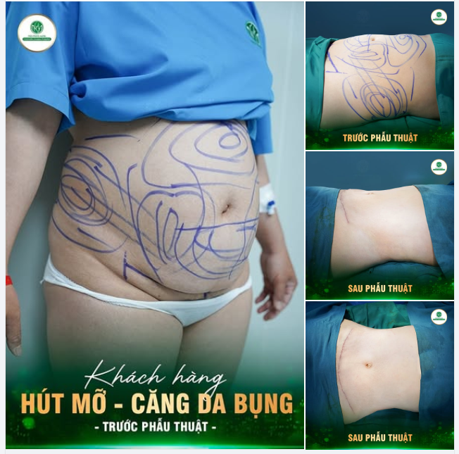 CHỊ NÀO BỤNG MỠ “PHÌ NHIÊU”