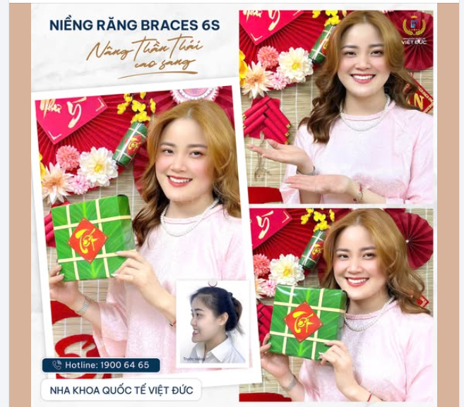 TỪ "CÔ GÁI RĂNG MÓM" ĐẾN NÀNG THƠ RẠNG RỠ – HÀNH TRÌNH 2 NĂM NIỀNG RĂNG CỦA HUỲNH THÚY HIỀN