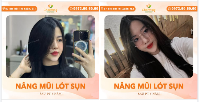 Nếu bạn muốn sở hữu một dáng mũi đẹp bền vững, nâng mũi lót sụn chính là giải pháp đáng để cân nhắc.