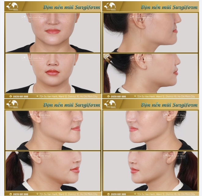 ĐỘN NỀN MŨI - Ph.ẫu th.uật giúp cải thiện gương mặt trở nên đầy đặn, trẻ trung.
