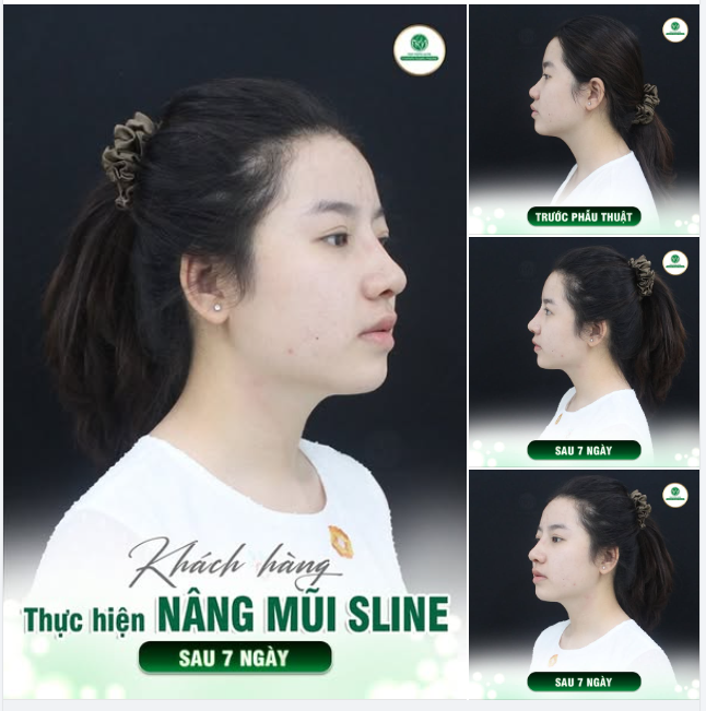 “THẢ THÍNH” DÁNG MŨI ĐẸP - CHỊ EM MÌNH CÓ “DÍNH”