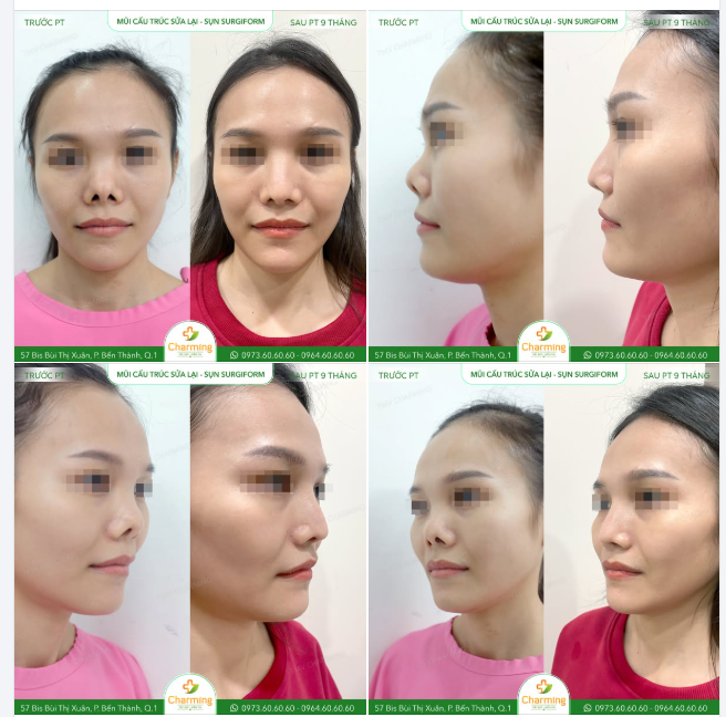 Sau khi từng nâng mũi nhưng chưa đạt như mong muốn, nàng quyết định tìm đến TMV Charming để thực hiện nâng mũi cấu trúc sửa lại bằng sụn Surgiform.