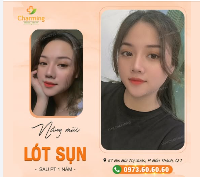 Nàng khách sau khi nâng mũi lót sụn tại TMV Charming nay đã tròn 1 năm. Kết quả thế nào? Vẫn đẹp, vẫn tự nhiên, vẫn khiến bao người phải khen ngợi.