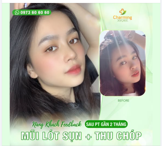 Nhìn nàng khách sau khi nâng mũi lót sụn kết hợp thu chóp tại Charming - Bs Nguyễn Khanh mà mê quá đi!