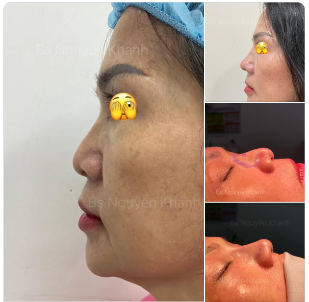 Chị khách đc bạn giới thiệu tới tư vấn làm mũi.