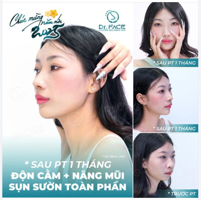 Có nhiều sự thay đổi đôi khi đến BS cũng phải bất ngờ. Trường hợp cô bạn làm combo nâng mũi sụn sườn + độn cằm này là một ví dụ.