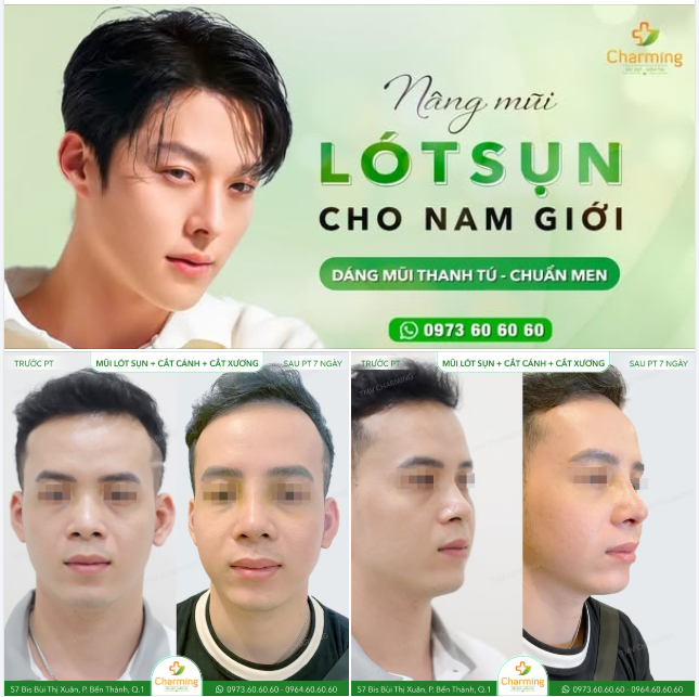 NÂNG MŨI Ở NAM GIỚI: XU HƯỚNG LÀM ĐẸP HIỆN ĐẠI