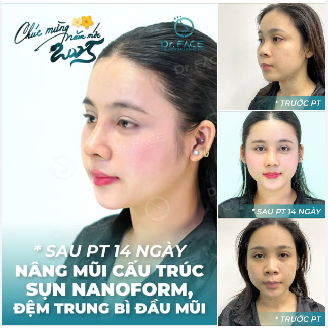 Ngày xưa ai nói em gương mặt thiếu điểm nhấn thì nay có thể xem lại. Sau một ca nâng mũi CẤU TRÚC ĐỆM TRUNG BÌ (đặt sống bằng sụn Nanoform) giờ em đã xinh hơn rất nhiều.